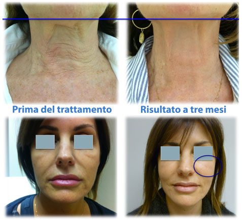 risultati_lift